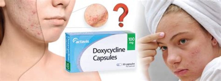 Doxycycline for acne: dosage, duration and side effects