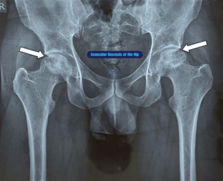 Is Angelica Panganiban Sick? Avascular Necrosis Diagnosis