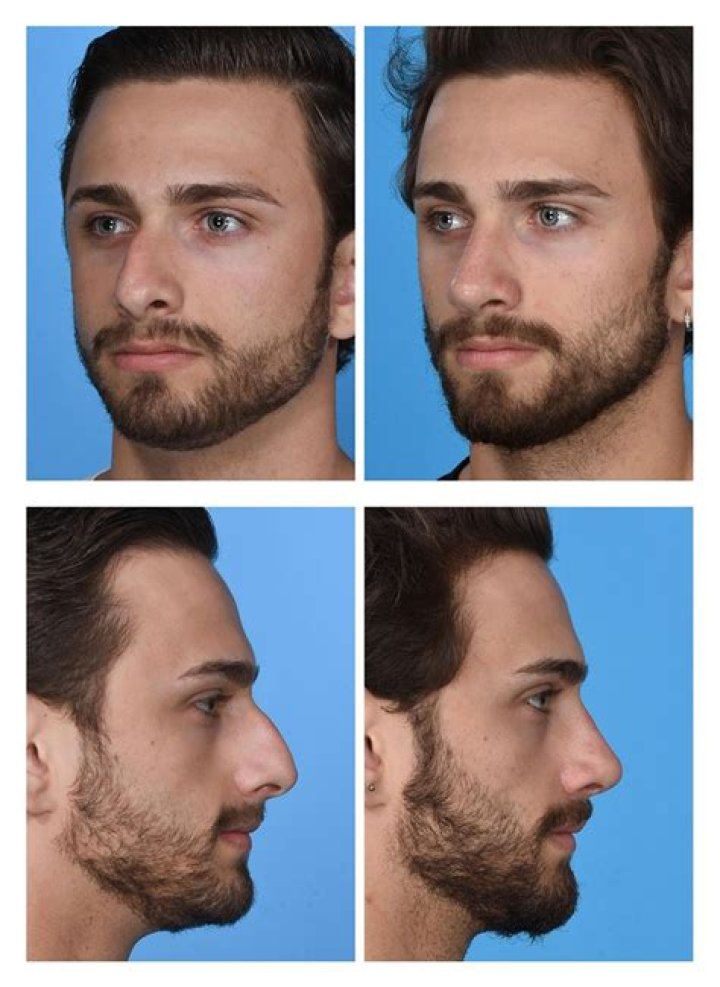 Ethan Slater Nose Job: Before and After Photos