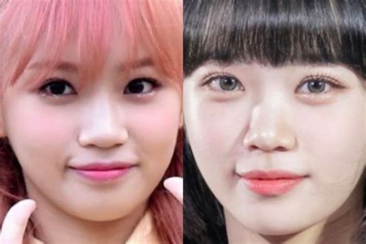 Kim Chaewon Plastic Surgery: Before And After Photos
