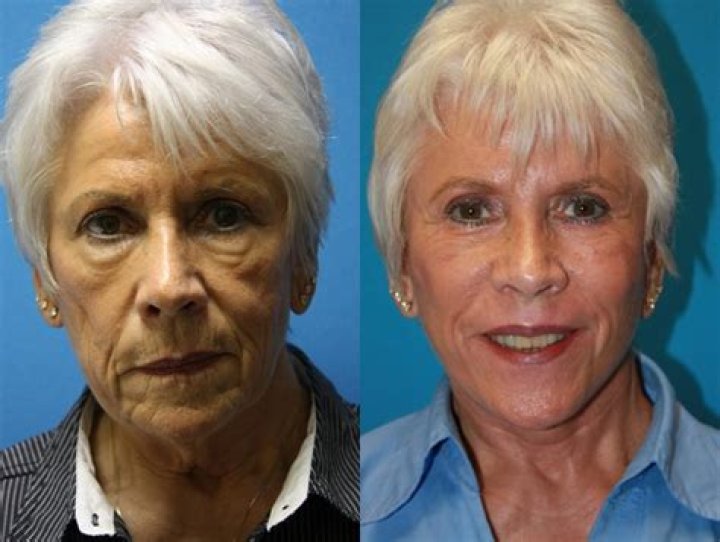 Mika Brzezinski Plastic Surgery: Before And After Photos