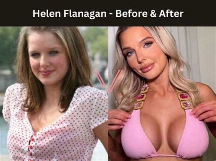 Nurys The Challenge Breast Implant: Plastic Surgery Before And After