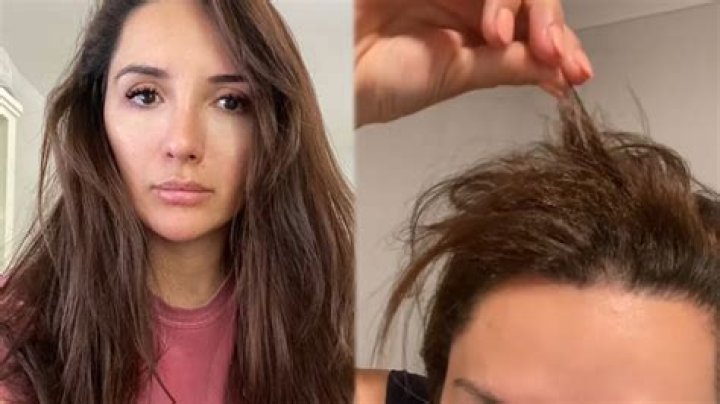 Bride Loses "50 to 70 Percent" of Her Hair in Treatment Disaster Just Weeks Before Wedding