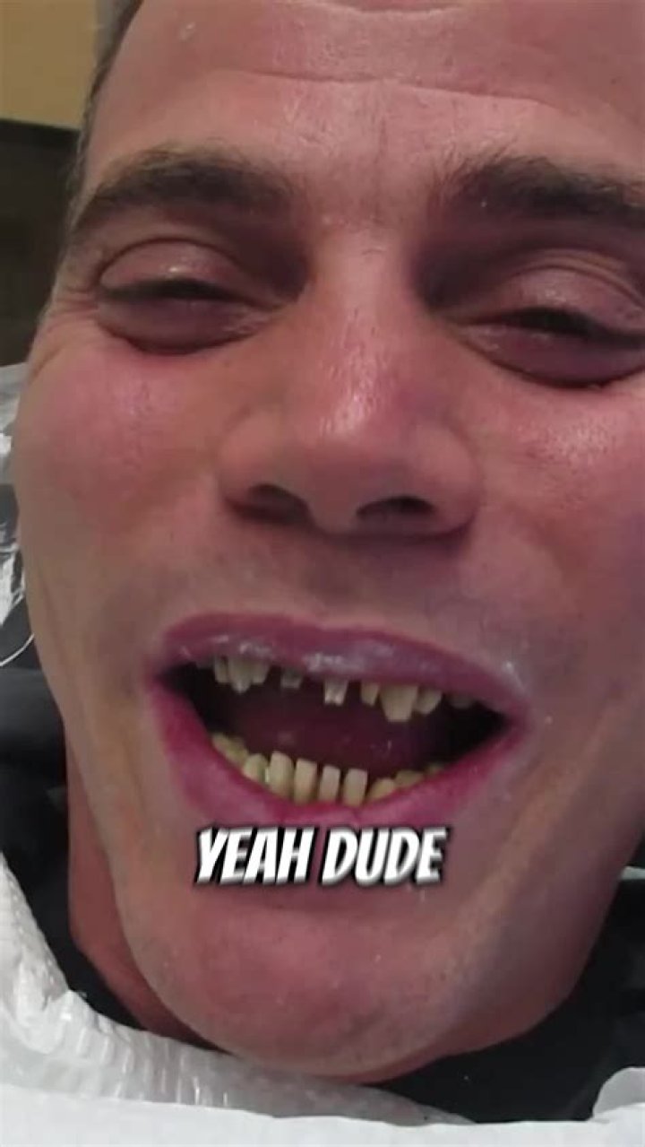 The Story of Steve-O’s Teeth: Three Different Sets of Fake Teeth for Three ‘Jackass’ Movies